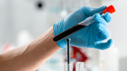   EEUU aprueba el primer test sanguíneo para ayudar a detectar el Alzhéimer 