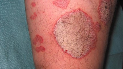   Día Mundial de la Psoriasis: Los mitos más comunes de la enfermedad 