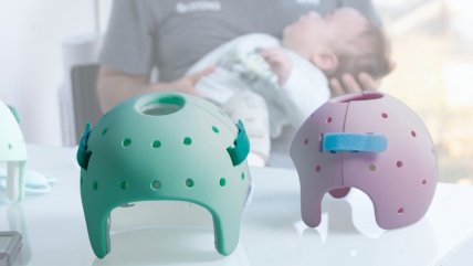   Casku 3D: La startup que agiliza la asimetría craneal en niños con malformaciones 
